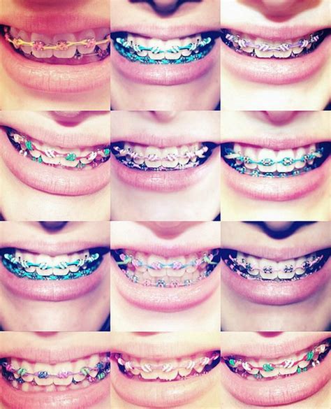 So if you're about to get new. Best Color Braces For Teeth | Colors Braces | Pinterest ...