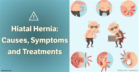 Hiatal Hernia Causes Symptoms And Treatment