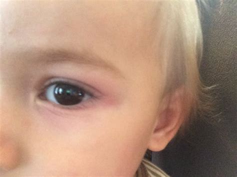Ot Toddler Has Red Puffy Eye Babycenter