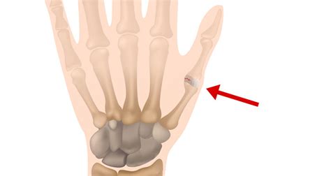 How To Rehab A Sprained Thumb