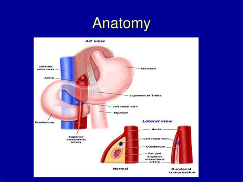 Ppt Superior Mesenteric Artery Sma Syndrome Powerpoint Presentation Id 1571556