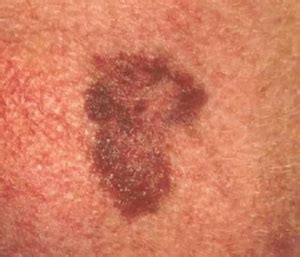 Many people in the world are ashamed of their dark skin patch on the elbows, knees, underarm and neck as well. How to Remove Dark Areas on Skin Fast from Acne ...