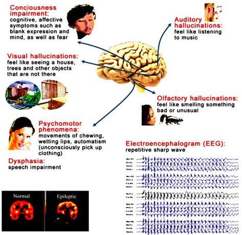Signs And Symptoms Signs And Symptoms Epilepsy