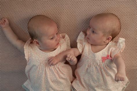 Rare Conjoined Twins Die One Day After Birth Immortal News
