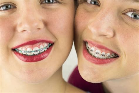 What Are The Reasons Behind Wearing Braces Alergiay Alimentos