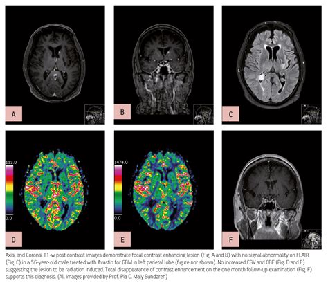 Advanced Mr Imaging Helps In Interpretation Of Brain Tumours Blog