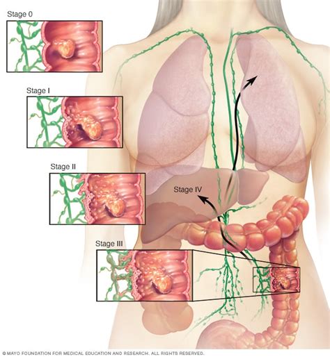 Illustration Showing Colon Cancer Stages