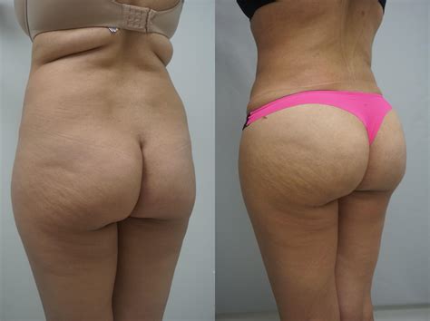 Before And After Plastic Surgery Results Top Surgeons Mexico