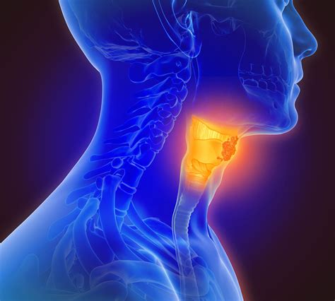 Câncer De Laringe Os Principais Sintomas Da Doença