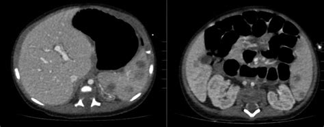 Ct Scans With Contrast Agent Of The Abdomen Show Multiple Hypodense