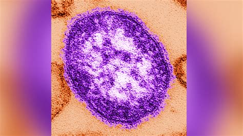 Why You Should And Shouldnt Worry About Measles Fox News