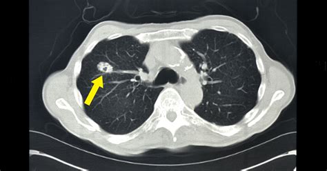 Lung Cancer Philips Mr Body Map