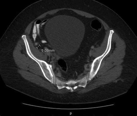 Atypical Appendicitis Preceded By Viral Illness Consultant360