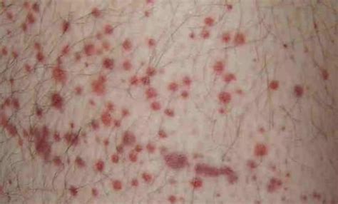 Petechiae Causes Treatments And Pictures Purple Spots On Skin Skin Spots Red Spots On Legs