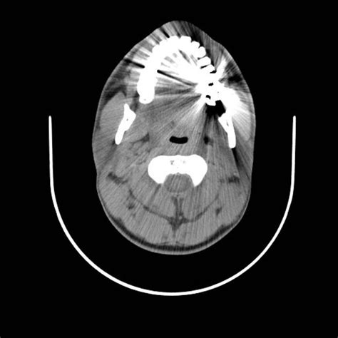 Acute Submandibular Sialadenitis Secondary To Ductal Stone Radiology