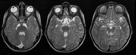 Dr Balaji Anvekars Neuroradiology Cases Joubert Syndrome Mri