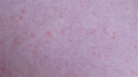 Baby Acne Cure And Treatment Baby Heat Rash Pictures