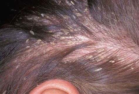 Hair Problems And Treatment Hair Loss Scalp Disorder Seborrheic