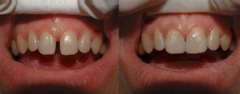 But all of them will fall under one of three nhs pricing bands. Teeth Bonding | South Dublin Dental