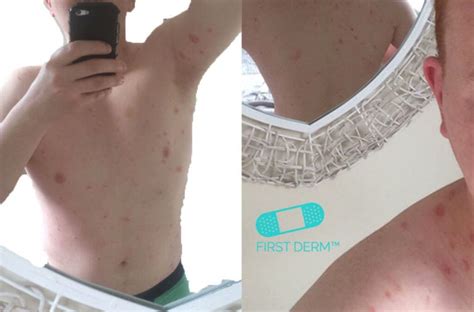 Itchy Rash Pictures 6 Most Common Cases And Their Treatment