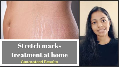 Stretch Marks Treatment In Hindi Causes Prevention Dermaroller