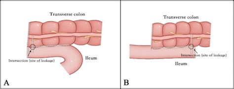 Bowel Resection An Anastomosis The Operative Review Of Surgery