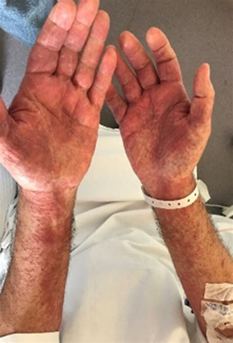 American Journal Of Case Reports Iodine Contrast Complex Rash