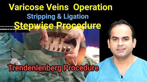 Varicose Veins Operation Stripping And Ligation Surgeon Dr Imtiaz Hussain Gold Medalist