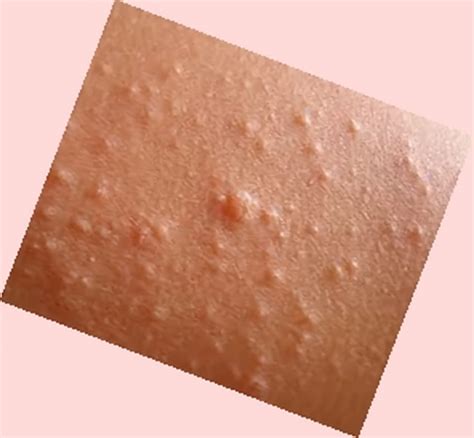 Bumps On Skin 0 Dorothee Padraig South West Skin Health Care