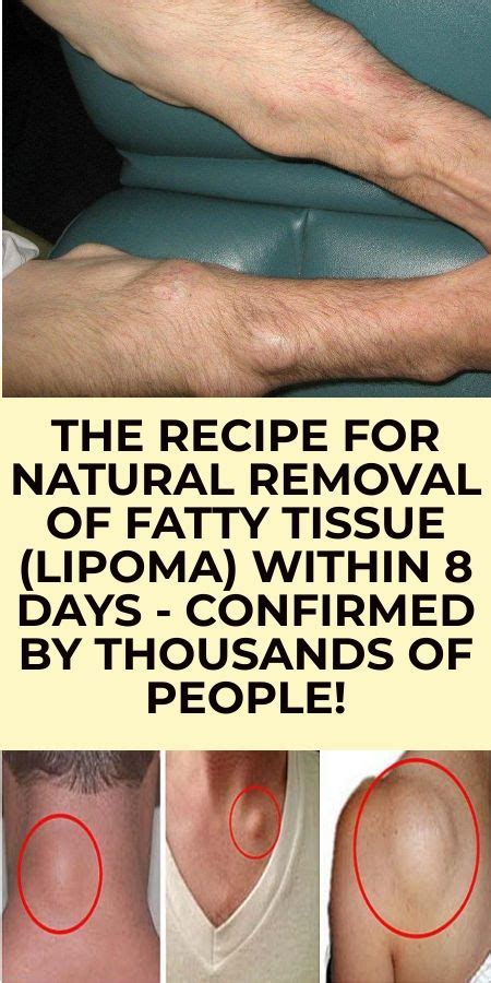 Recipe For Natural Removal Of Fatty Tissue Lipoma Within 8 Days