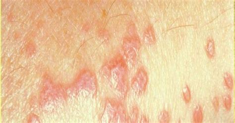 Lichen Planus Skin Rash