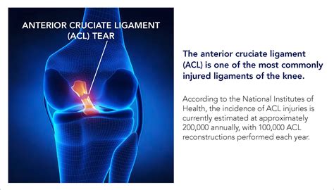 Preventing Acl Tears In Young Athletes