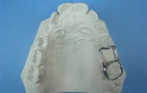 Space Maintainer Accutech Orthodontic Labs