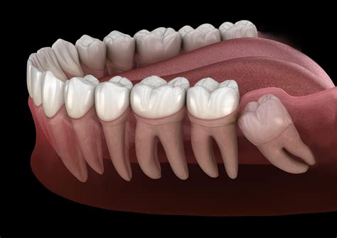 Full Bony Impacted Wisdom Teeth An Overview Best Dental