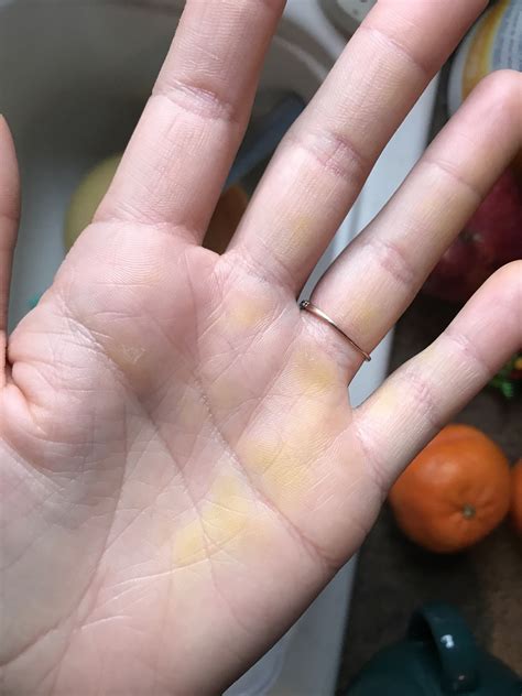 Yellow On Hands Like Highlighter Except Its Not Health