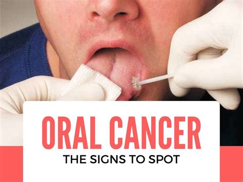 Oral Cancer 10 Oral Cancer Symptoms