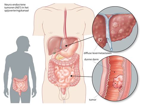 Neuro Endocriene Tumoren Oncozon