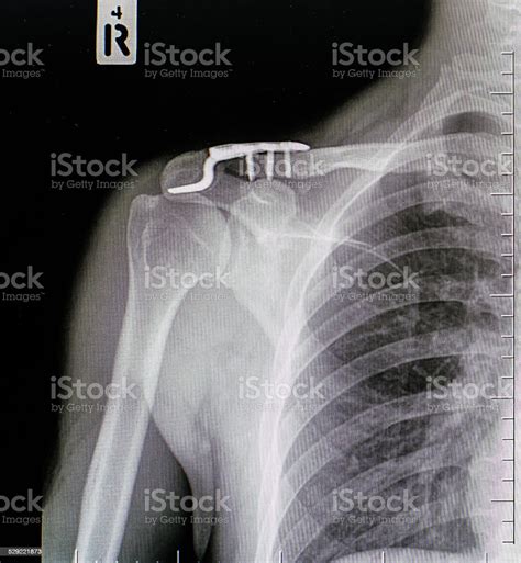 X Ray Of Collarbone Stock Photo Download Image Now Anatomy Blue