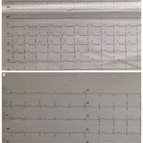A Electrocardiogram Showing Mild Anterior St Elevation And Negative T