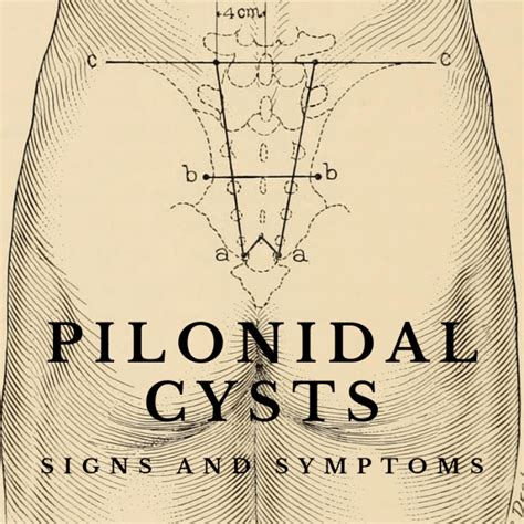 Diagram Of Pilonidal Cyst
