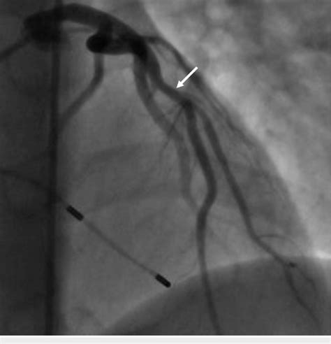 Left anterior descending artery d1: Coronary angiography showing revascularized LAD and ...