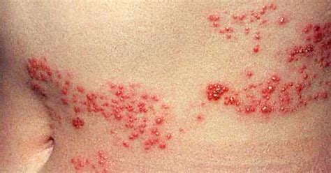 Is It Shingles Myths About Painful Illness Graphic Images CBS News