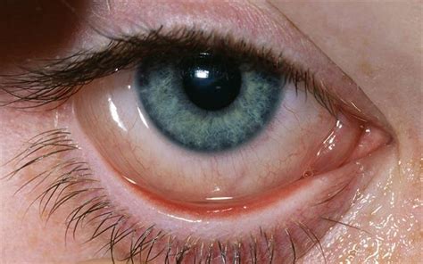Increased Reports Of Eye Irritation With Xalatan Mims Online