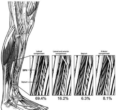 The 4 Main Patterns Of Superficial Peroneal Nerve Anatomy And Crural