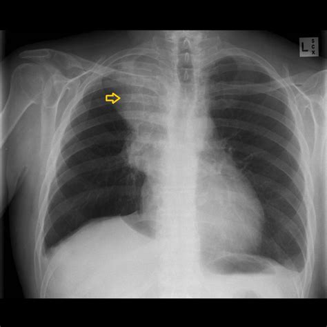 Cushings Syndrome Chest X Ray Wikidoc
