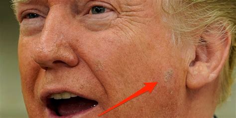 What Is That Spot On Donald Trumps Face Probably Keratosis Business