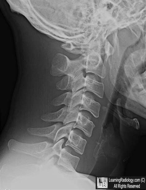 Learningradiology Atlanto Axial Subluxation C1 C2 Aa Dislocation