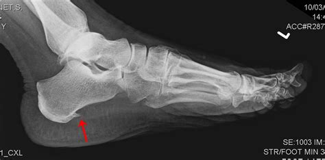 Heel Spur Treatment For Runners Relieve Foot Pain During Pregnancy