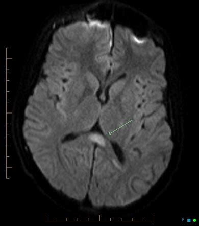 Cytotoxic Lesions Of The Corpus Callosum Cloccs Radiology Reference Article Radiopaedia Org