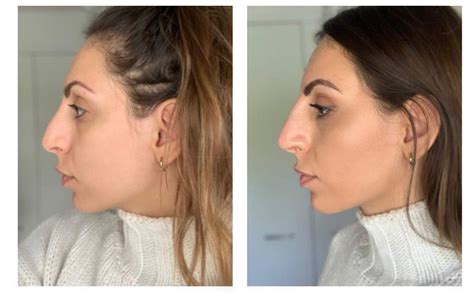 Hook Nose Before And After Before And After Photo Of A 24 Year Old